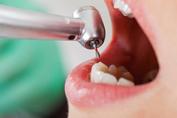 Best Emergency Dental Care for Broken or Chipped Teeth in Clarinda, IA
